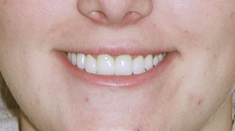 After photo of dental treatment